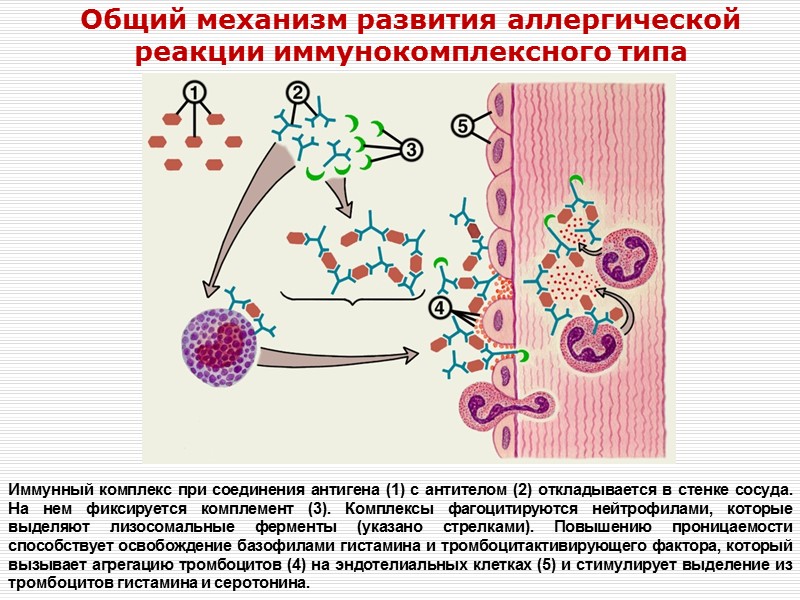 Общий механизм развития аллергической реакции иммунокомплексного типа Иммунный комплекс при соединения антигена (1) с